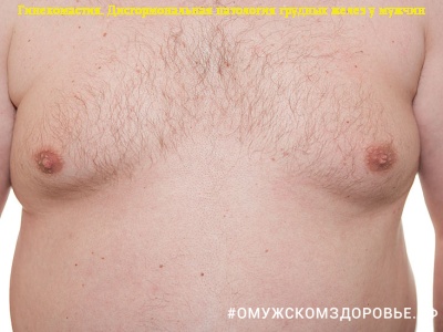Дисгормональная гиперплазия грудных желез
