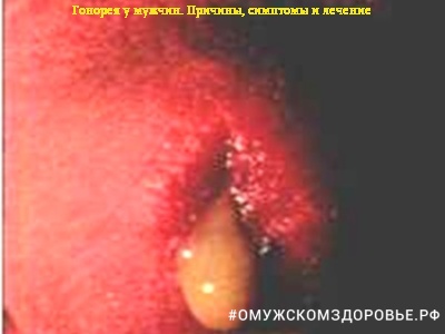 Гонорея у мужчин. Причины, симптомы и лечение