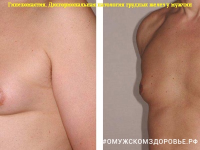 Гинекомастия. Дисгормональная патология грудных желез у мужчин
