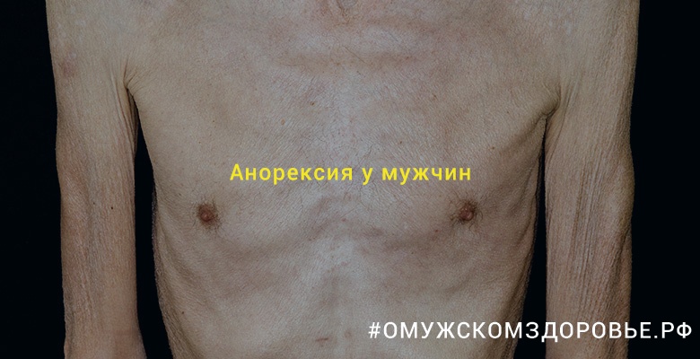 Анорексия у мужчин