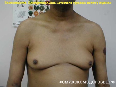 Гинекомастия у мужчины