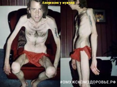 Анорексия у мужчин