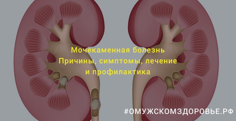 Мочекаменная болезнь у мужчин. Причины, симптомы, лечение и профилактика