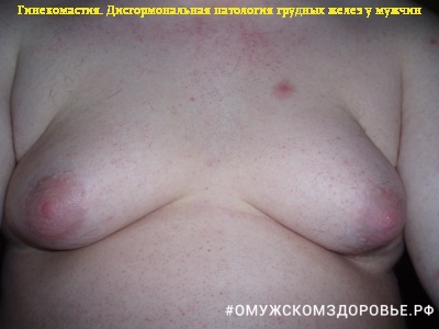 Дисгормональная патология грудных желез у мужчины